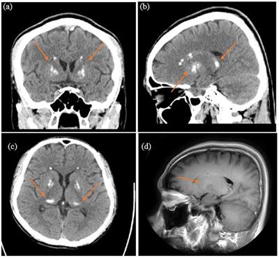 Idiopathic young-onset Fahr’s disease with schizophrenia-like presentation: a case report